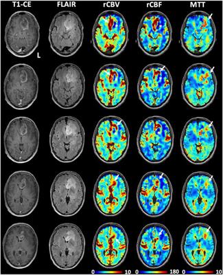 Transient deoxyhemoglobin formation as a contrast for perfusion MRI studies in patients with brain tumors: a feasibility study